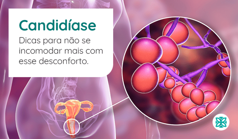 Candidíase - Dicas e Prevenção | Botica Alternativa